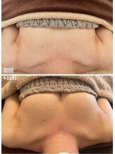 美人バスト 新宿店/☆姉妹店バストアップ症例写真☆