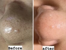 リンカ(Rinca)/毛穴エクストラクション尾張旭