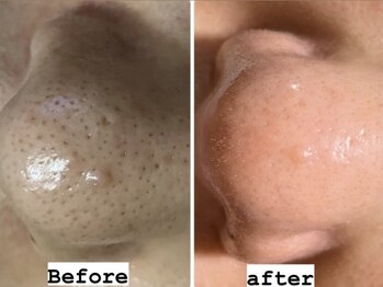 リンカ(Rinca)/毛穴エクストラクション尾張旭