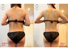 ルフレ(REFLET)/【事例6】Before/After/痩身