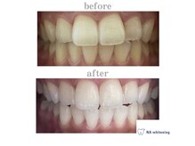 エヌエーホワイトニング たまプラーザ店(NAホワイトニング)/ビフォーアフター