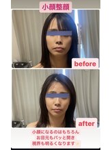 カラーリリー(calla lily)/小顔整顔