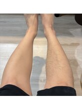 トゥインクル(Twinkle)/濃い毛もしっかり脱毛！