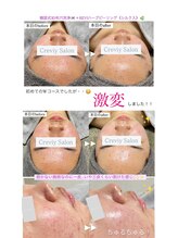 クレヴィー(Creviy)/3D毛穴洗浄＆ハーブピーリング