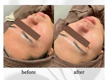 アン ビューティー(ann beauty)/【症例写真】20代前半男性
