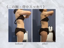 ジュプン 長崎/二の腕・背中スッキリ★