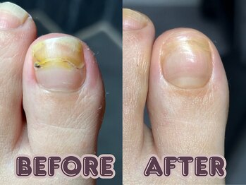 ポドロ ウィズ ニコルル 大阪天満店(PoDoLo with Nicolulu)/【二枚爪】フットケア大阪・梅田