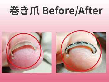 スロース鍼灸整体院(SLOTH鍼灸整体院)/巻き爪の改善例