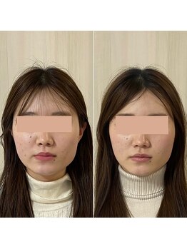 サロン ウェル(SALON WELL)/【20代 小顔矯正/エラ張り】