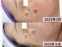 他店で満足出来なかったお肌の悩みお任せ下さい♪本気のシミケア