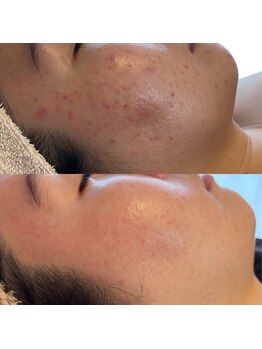 シグネット(Cygnet)/HAABREPRO/ハーブリプロ