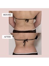 ミーティス/インディバで反り腰ケア♪