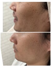 オリエンス(oriens)/ハーブピーリング3回