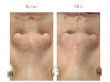 アワイズ(AY's)/毛穴スッキリ体験☆