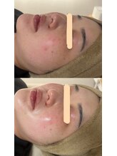 サロンモア(salon More)/LED美容