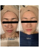 ブランシュール/小顔タイト×エンビロン