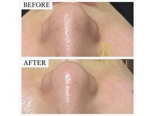 モテ 新宿店(Mote)/ハイドラ毛穴洗浄＋艶肌Wax 新宿