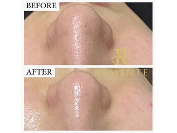 モテ 新宿店(Mote)/ハイドラ毛穴洗浄＋艶肌Wax 新宿