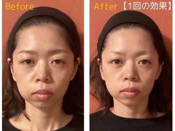 ロイヤリティ(ROYALTY)/左右差、目元もぱっちりに☆