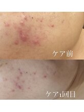ミラージュ(Milarju)/ニキビケアにお悩みの方必見♪