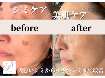 パールホワイトニングの写真