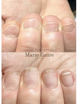 マリーロール 天王寺店(Marie Laure)/自爪育成/深爪矯正/ネイルケア