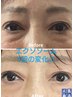 [話題の韓国美容]ILLONハーブピーリング＆エクソソーム微細針セット￥15,000