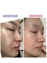 リラベル(Lira Belle)/マスク荒れの跡が薄くなった