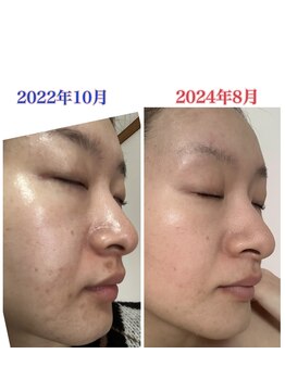 リラベル(Lira Belle)/マスク荒れの跡が薄くなった