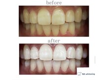 エヌエーホワイトニング たまプラーザ店(NAホワイトニング)/ビフォーアフター