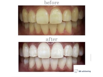 エヌエーホワイトニング たまプラーザ店(NAホワイトニング)/ビフォーアフター