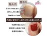 【FOOT】巻爪改善ブーツでの圧迫対策 B／Sブレイス+シェラックLuxeワンカラー