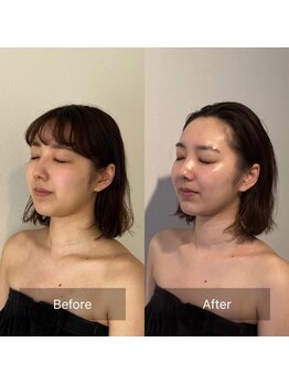 サロンウム(Salon umu)/造顔小顔1回の施術効果
