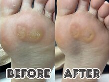 ポドロ ウィズ ニコルル 大阪天満店(PoDoLo with Nicolulu)/【タコ】フットケア大阪・梅田