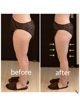 リラ(RILA)/キャビテーション+マッサージ