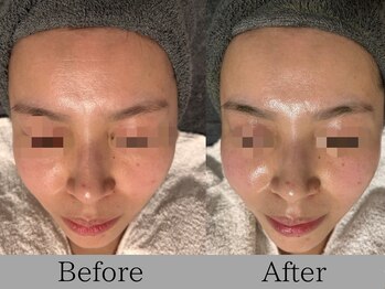 ルミライズ(lumirise)/〈1回目での効果〉