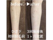 モア男子(MORE男子)/ひざ下症例