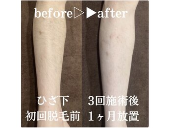 モア男子(MORE男子)/ひざ下症例