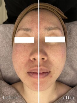 メゾンリュバン 梅田店(Maison Ruban)/エステ版オンダリフトプロ