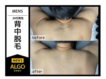 アルゴ 南茨木駅前店(ALGO)/【メンズ全身脱毛】