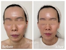 ダルセーニョ/☆「理想の小顔への道のり」☆