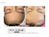 10歳～20歳まで　レディース　顔まるごと脱毛￥5.800→￥4.400