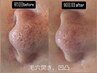 人気No.1【本気の毛穴改善、開き、詰まり】全顔 プラズマニア/毛穴施術