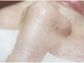 ココルアナ(COCO LUANA)の写真/《☆脱いちご鼻☆》黒ずみ毛穴洗浄！ツルツル毛穴レス♪70分¥3960