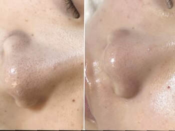 サロン エデンプラス(salon eden PLUS)/鼻の黒ずみ毛穴の開きもご相談を