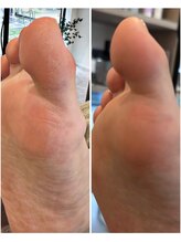 ケアプラス(care plus)/足裏角質ケア