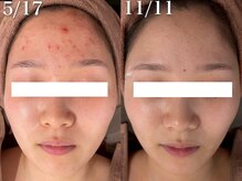 ホワイトアクア 梅田本店(WHITE AQUA)/ハーブピーリング/大阪/梅田