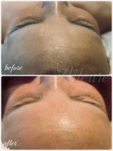 エルール トータルビューティ(Aileure total beauty)/ソフトピール×Waxフェイシャル