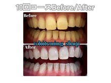 しっかり白くしたい方は回数券がお得☆初回購入で特典付き♪