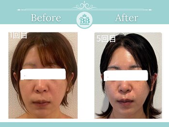 美人バスト 本厚木店/【小顔コルギ】☆症例